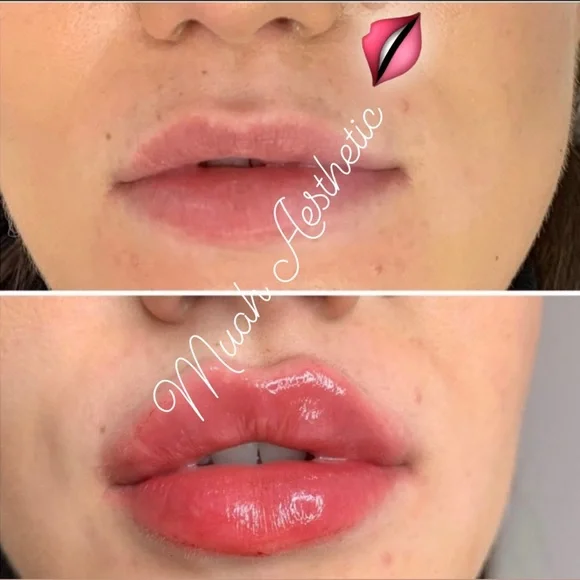 Hyaluronic acid - Picture 2 of 2